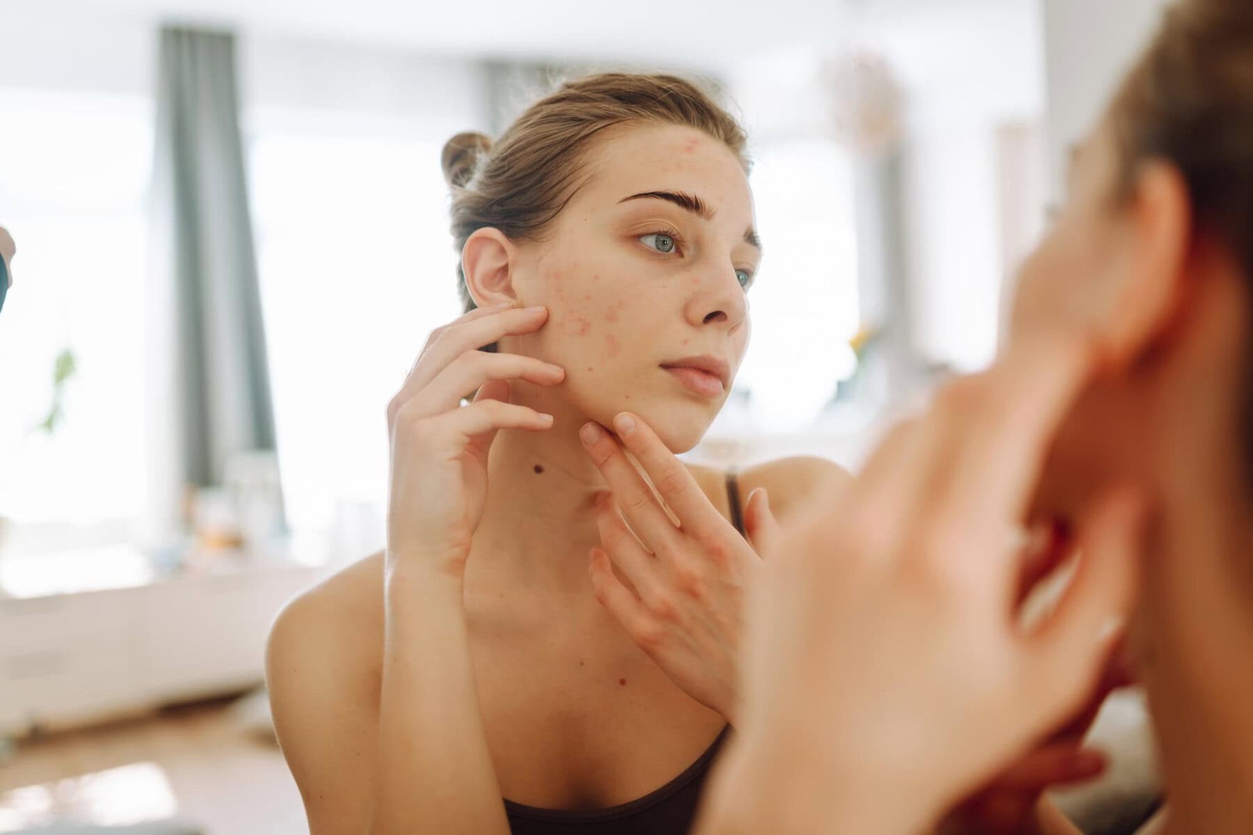 acne e sole effetto rebound Acne e sole effetto rebound