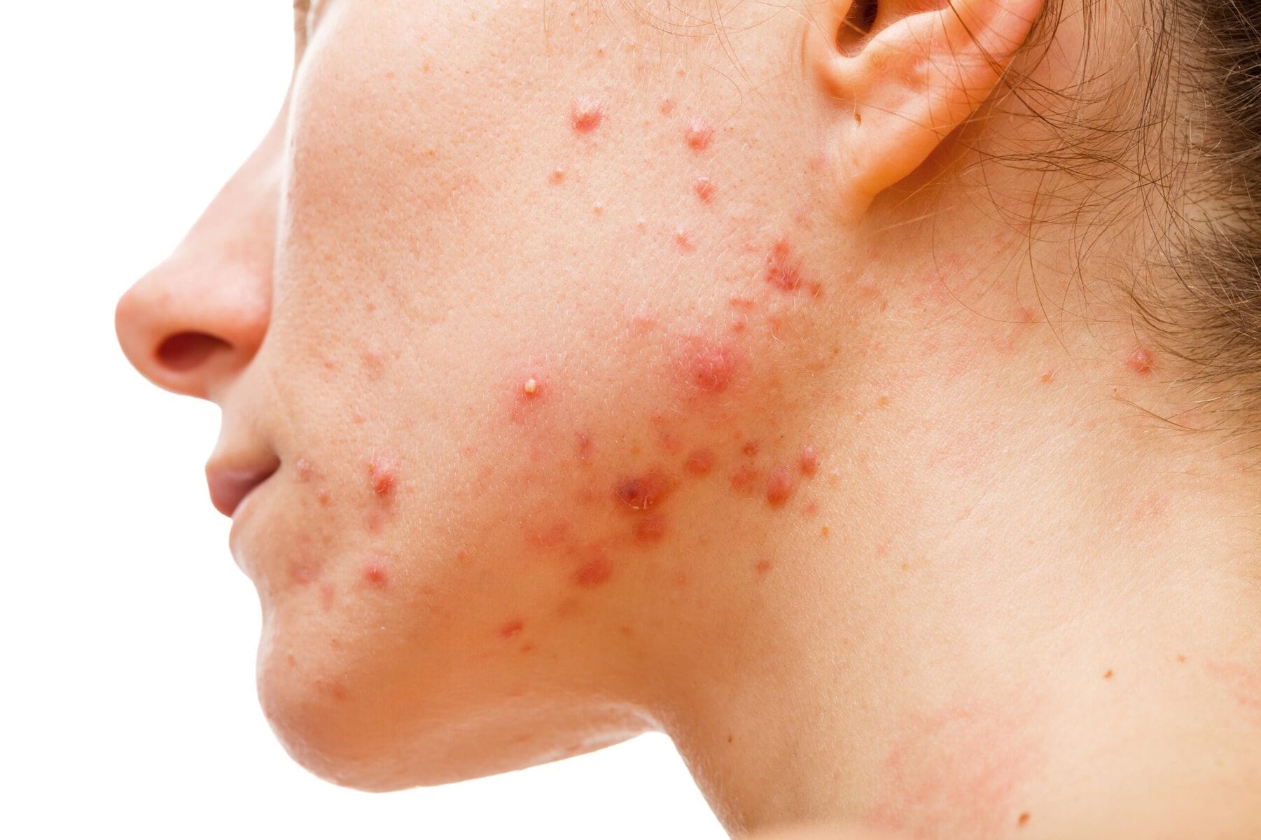 acne e sole infiammazione scaled Acne e sole infiammazione