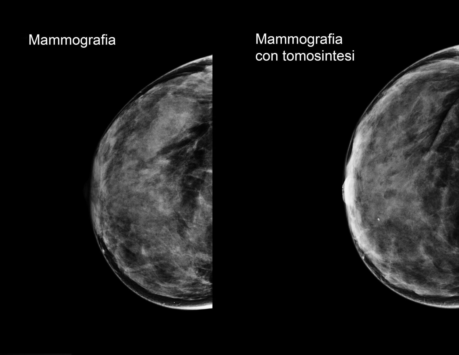 Mammografia con tomosintesi differenze Mammografia con tomosintesi differenze
